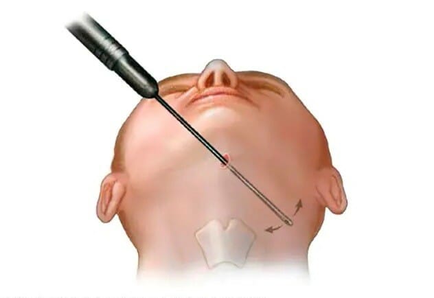 Cost of Liposuction in Montreal